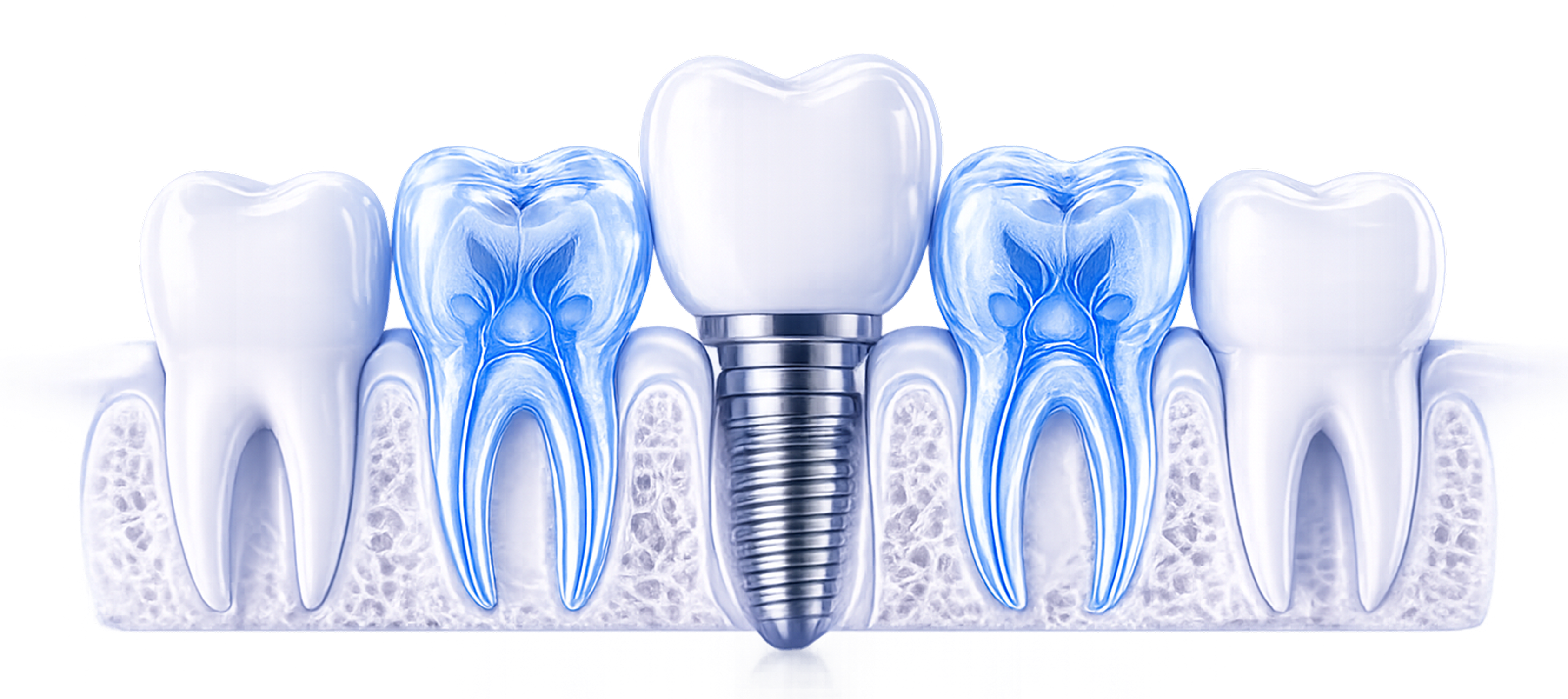 Dental implant illustration with enamel, pulp, and crown protection