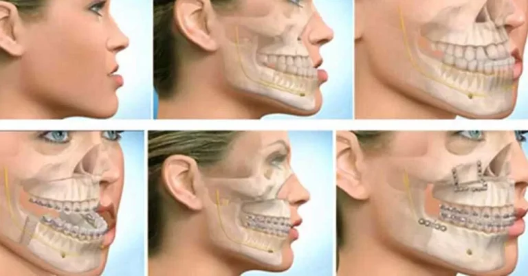 Jaw procedures
