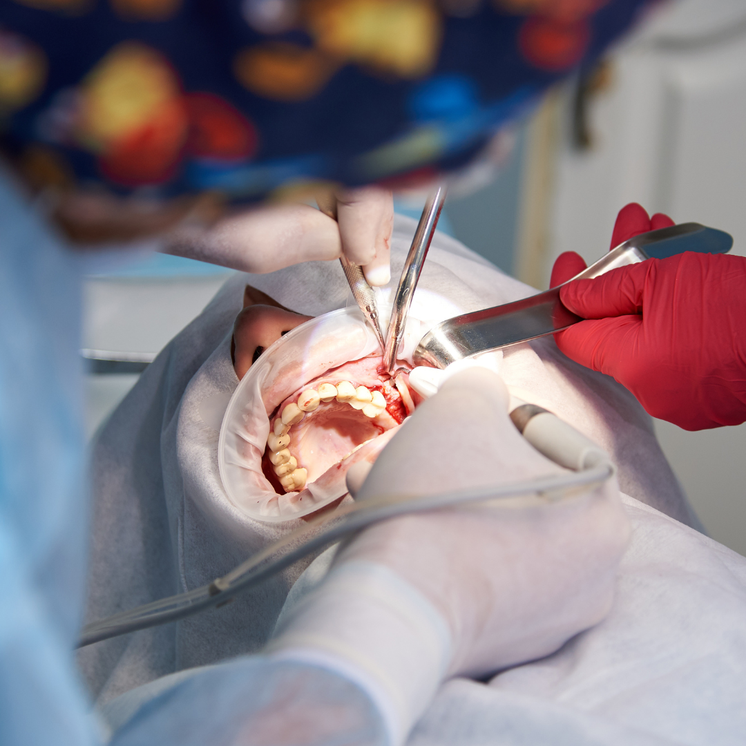 Minor Oral Surgery
