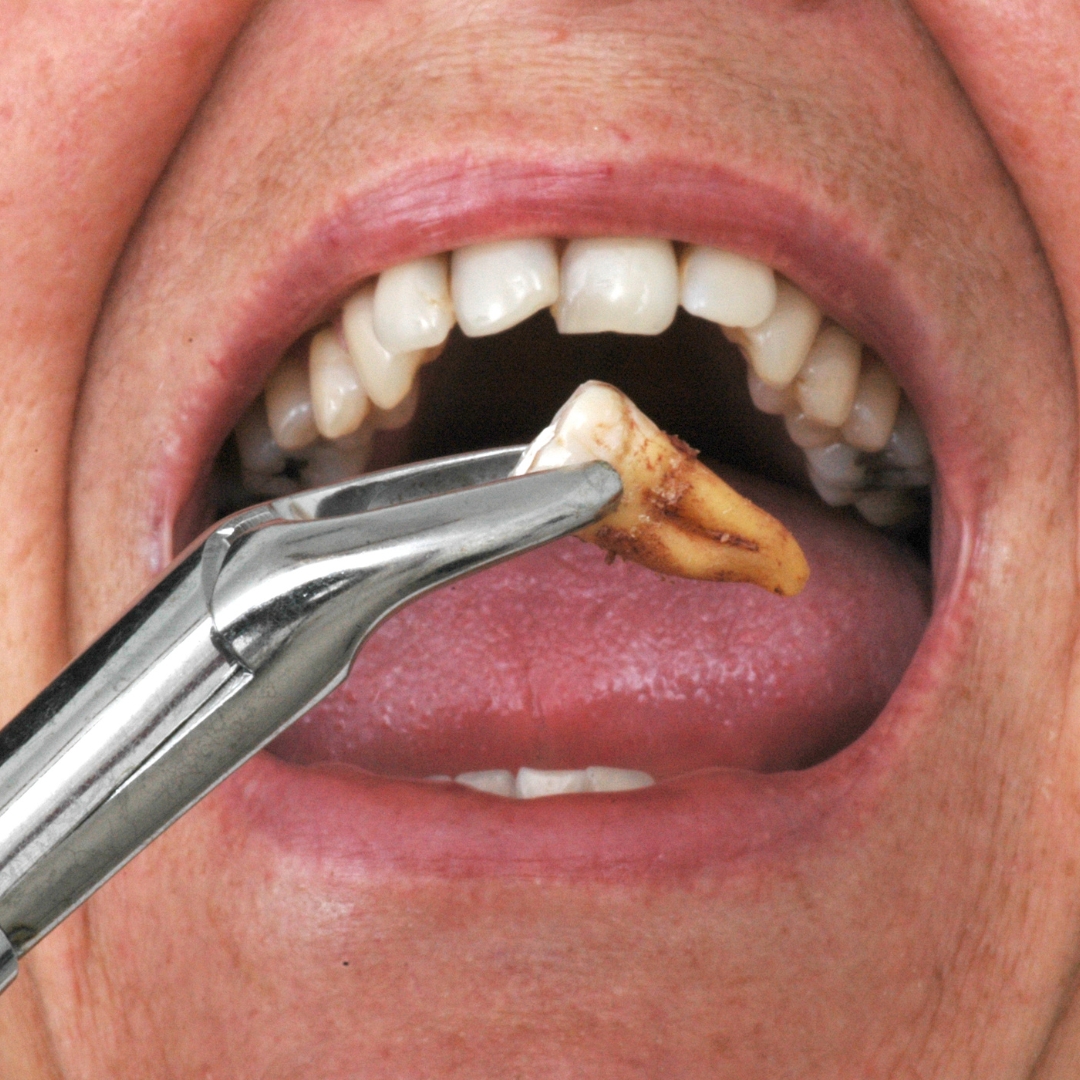 Tooth Extraction