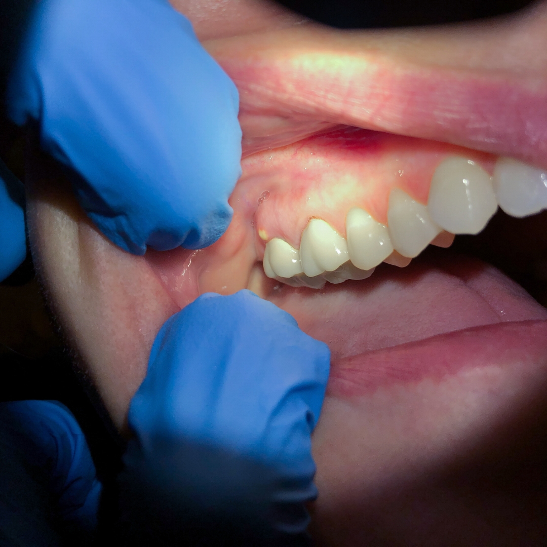 Dental Abscess Drainage