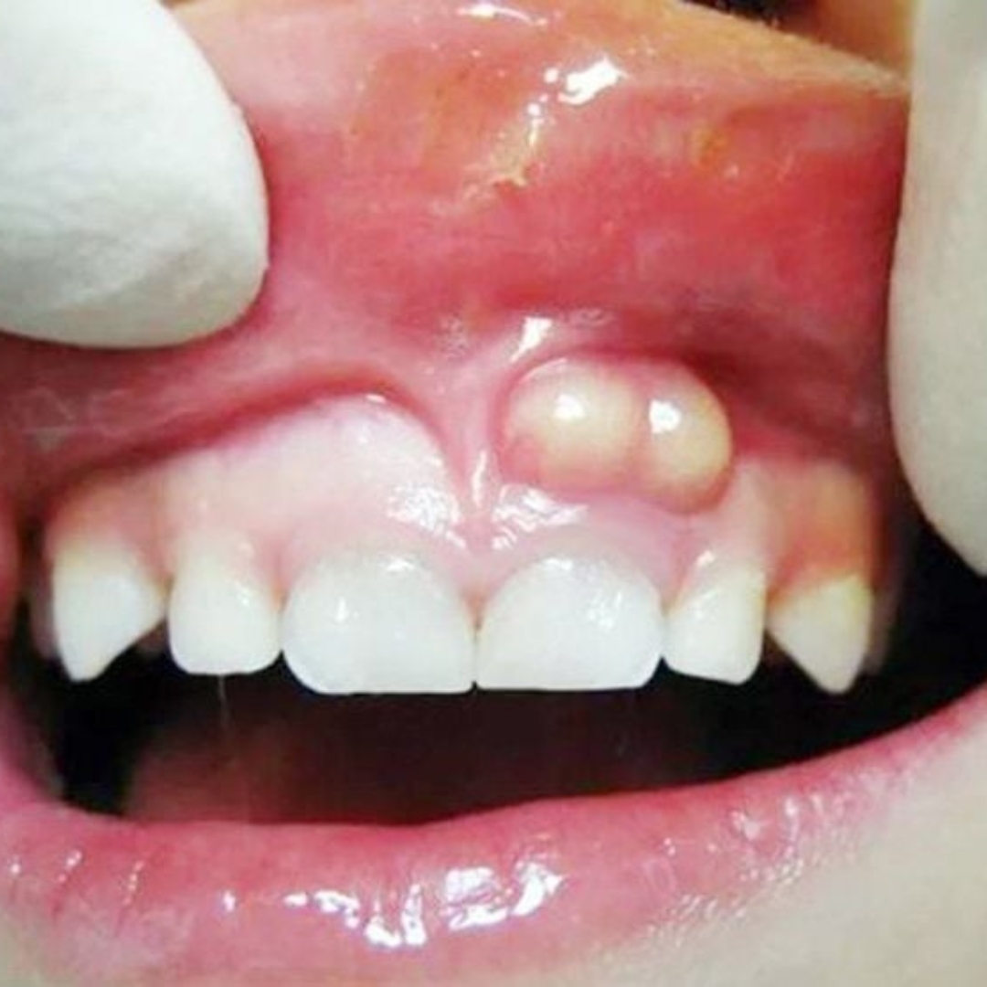 Oral Cyst Removal