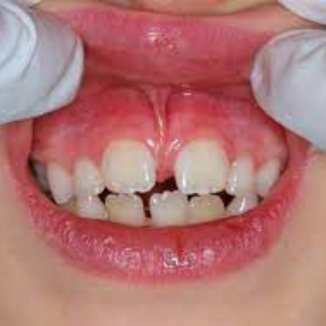 Frenectomy