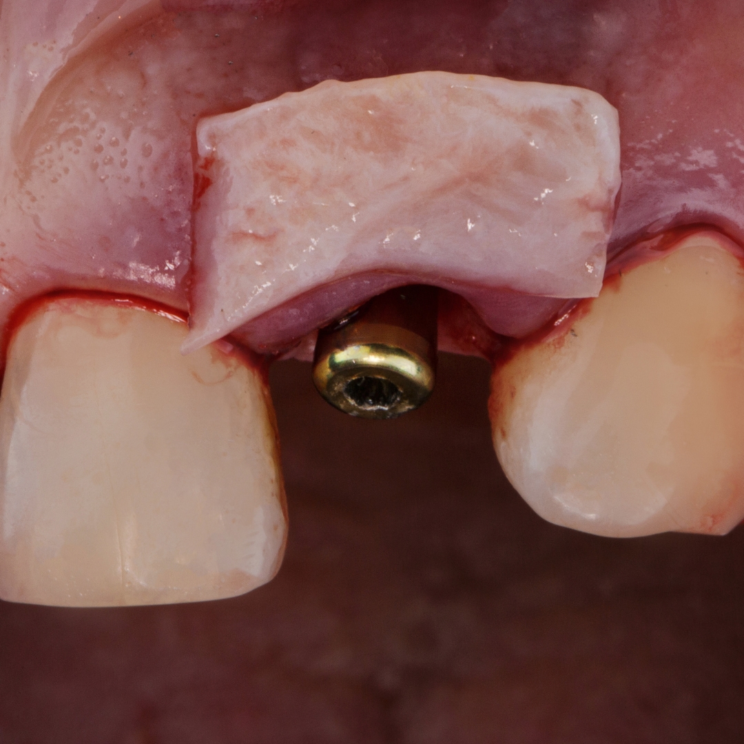 Gum Tissue Removal