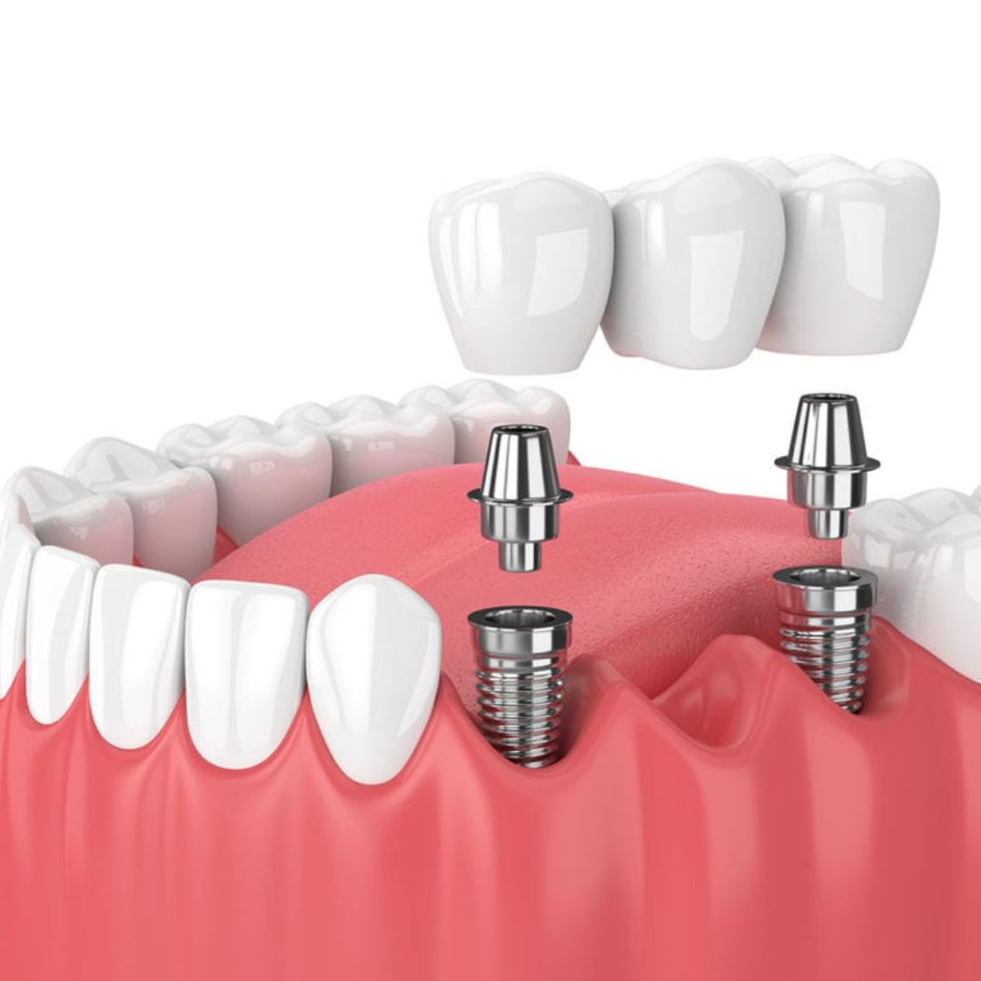 Multiple dental implants supporting a dental bridge for restored functionality.