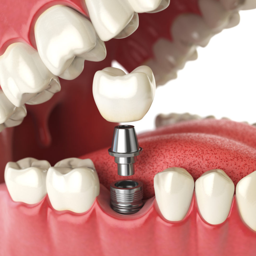 Close-up of a single dental implant replacing a missing tooth.