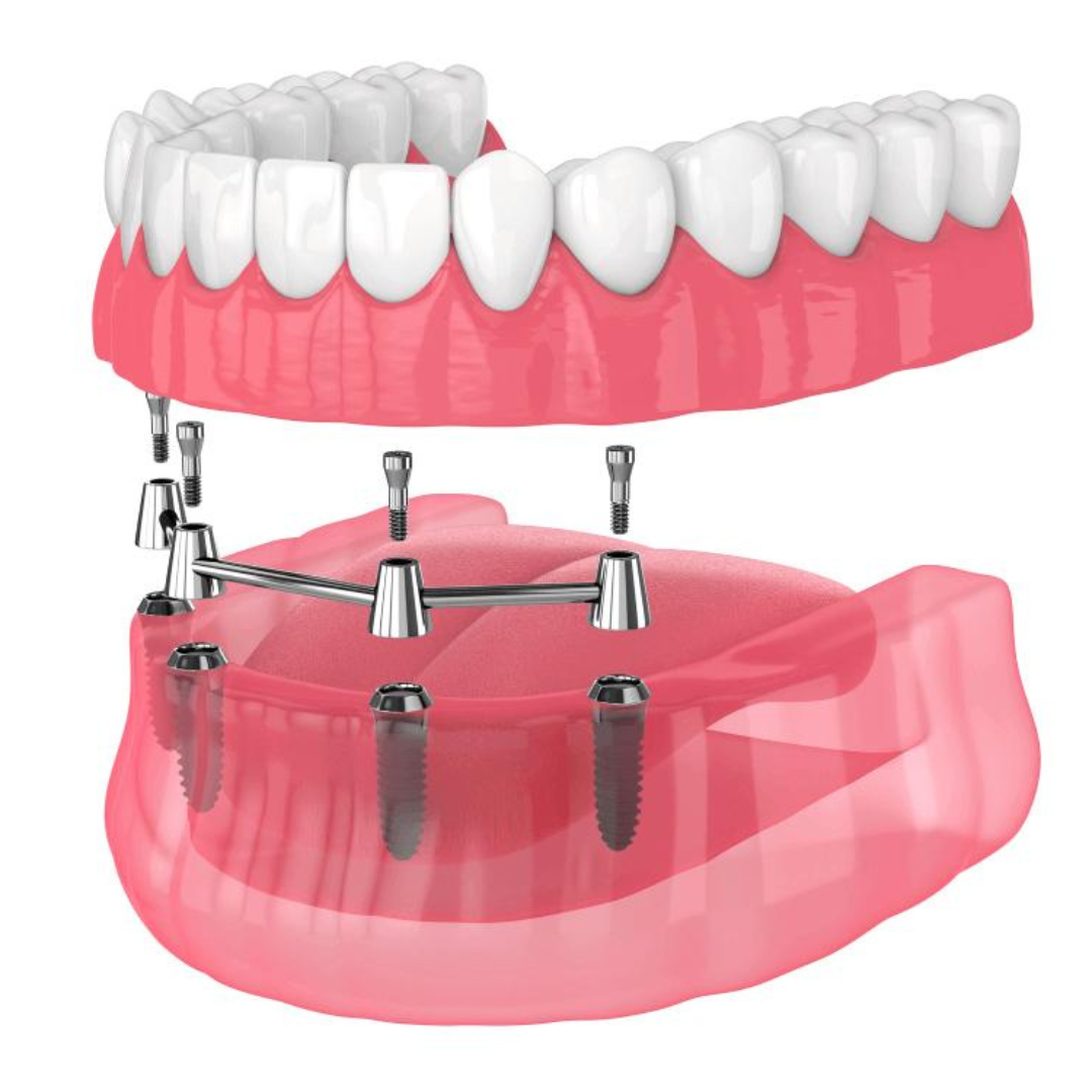 Full-mouth dental implants restoring the complete upper and lower arches.