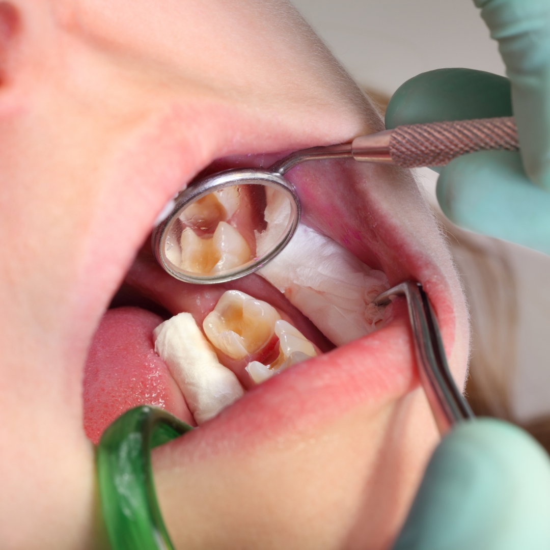 Pediatric dentist providing fluoride treatment for cavity prevention