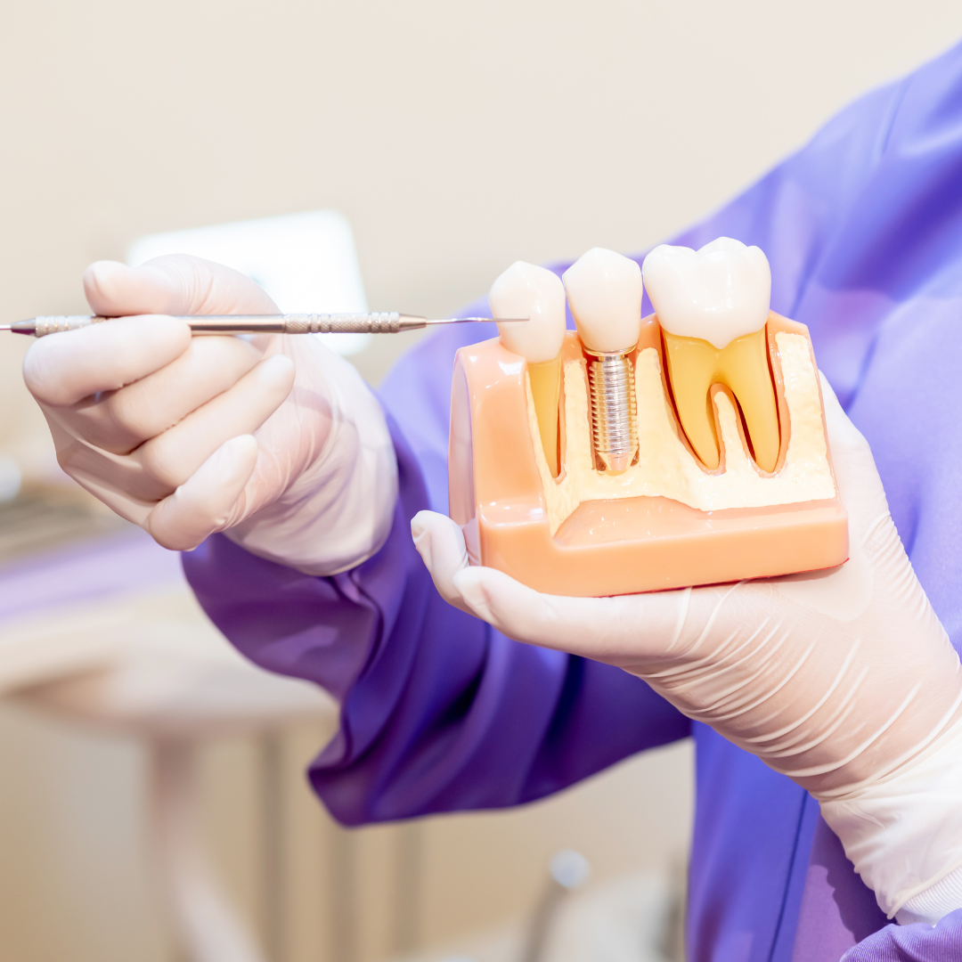 Dental implants for a natural and lasting smile restoration.
