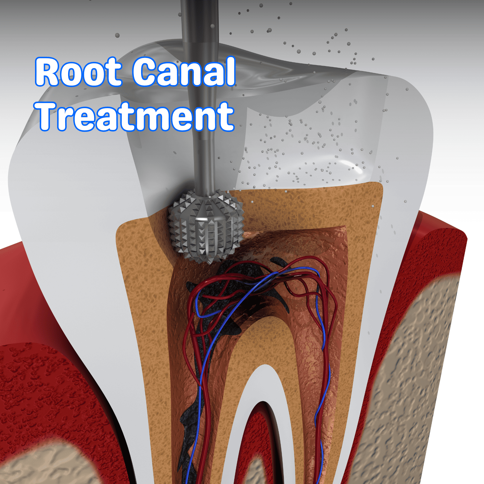 Pediatric root canal treatment at ManDent Dental Clinic – Gentle care for kids.