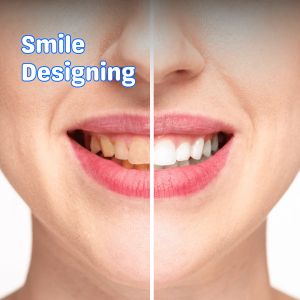 Smile designing services to enhance your smile