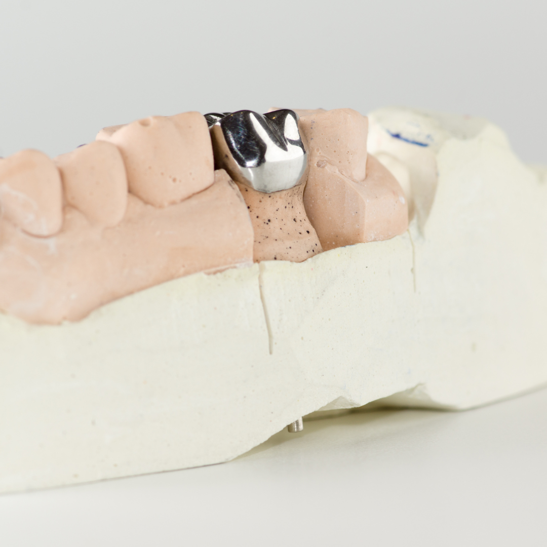 Metal Crowns