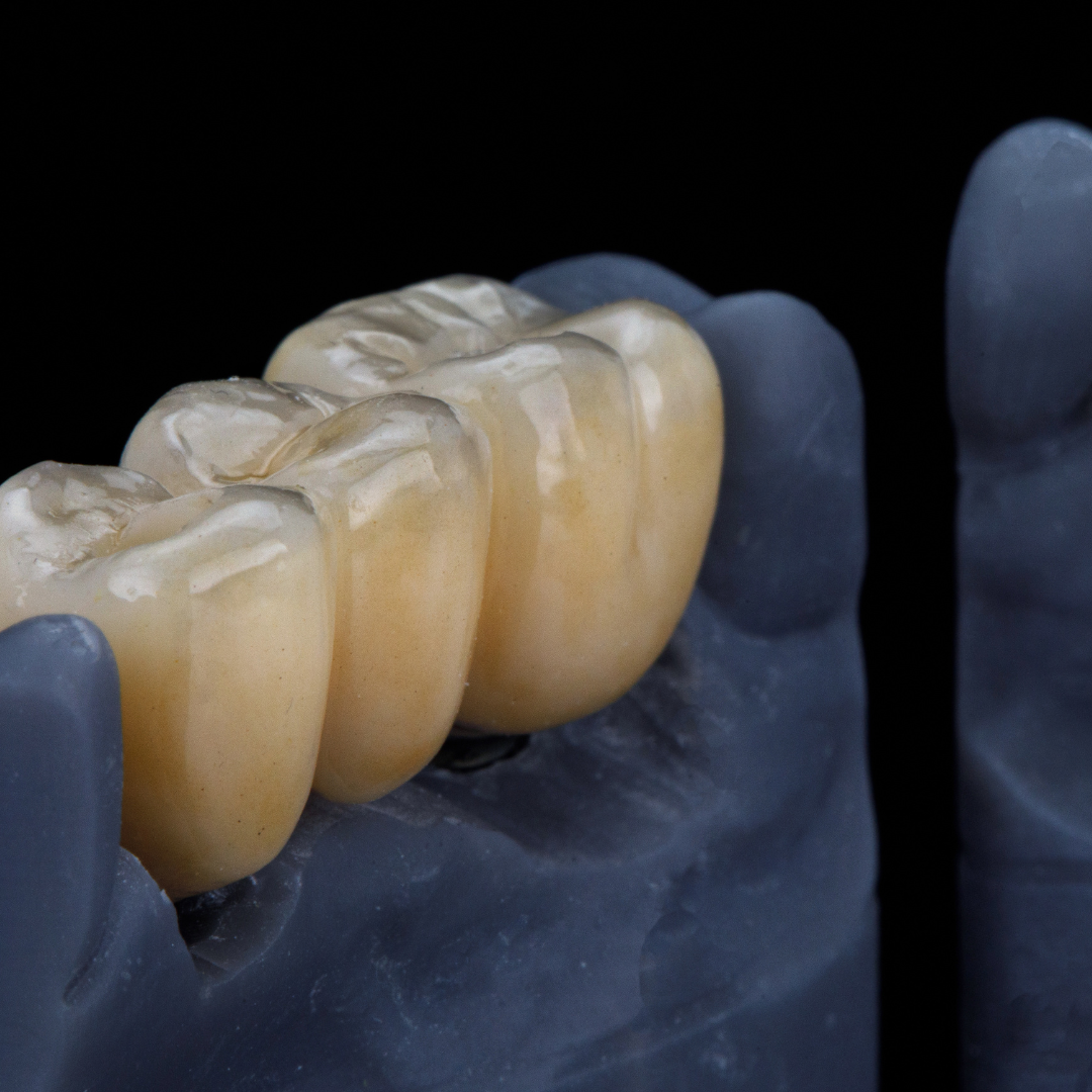 Zirconia Crowns